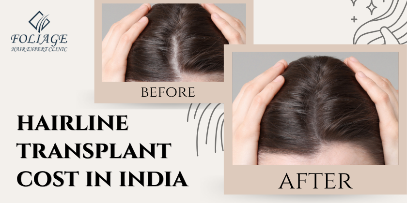 hairline transplant cost in india