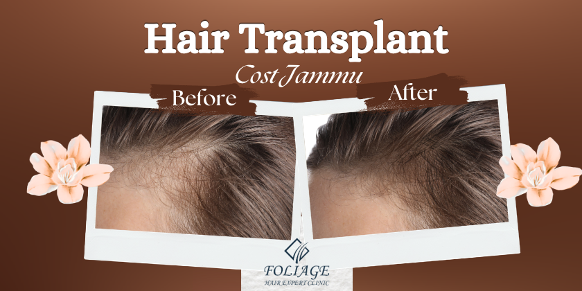 Hair transplant cost jammu